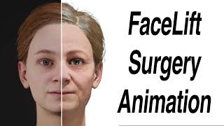 FaceLift Surgery Animation [upl. by Suoivatnod]