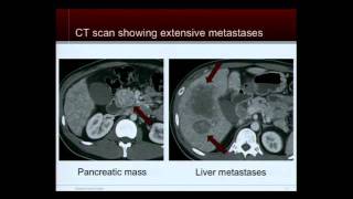 Tumor Board Case Discussions Neuroendocrine Tumor Patient Education Conference [upl. by Matilde401]