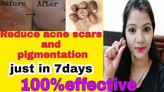 7days challenge remove acne scars  pigmentation with nutmeg jayfal face pack for glowing skin [upl. by Saibot969]