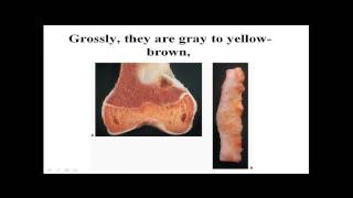 fibrous and fibroosseous tumors part 1 [upl. by Ynnohj673]