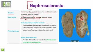 تصلب الكلية  Nephrosclerosis [upl. by Enrev]