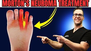 Numbness or Tingling in the Feet or Toes Mortons Neuroma Treatment [upl. by Adnimra409]