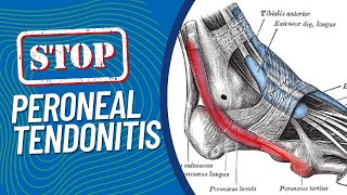 ResearchBacked Treatments for Peroneal Tendonitis Pain on the Outside of Your Foot When Running [upl. by Bernita]