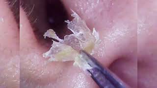 Ultimate Ear Wax Removal  Satisfying Ear Cleaning for Clear 4 [upl. by Noremac]