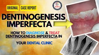 DENTINOGENESIS IMPERFECTA AN ORIGINAL CASE REPORT dentist youtubegrowth youtubegrow dentistry [upl. by Eesdnil686]