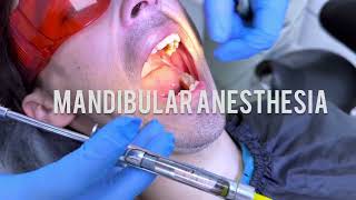 Techniques for Mandibular Anaesthesia  VaziraniAkinosi Mandibular Block Technique dentist dental [upl. by Anirtap]