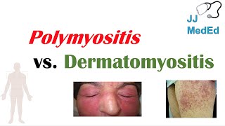 Idiopathic Inflammatory Myopathies  Polymyositis vs Dermatomyositis [upl. by Yreved327]