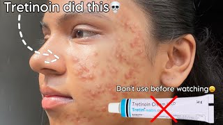 Tretinoin mistakes that ruined my skin 😫 tretinoin skincare beauty [upl. by Gabrielle]