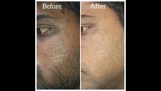 Tan skin or pigmented skin try our detan treatment smaavins vadapalani cosmetic call 9962234451 [upl. by Kirch]