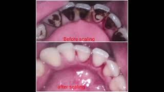 PROFESSIONAL DENTAL CLEANING  SCALING amp POLISHING  BEFORE VS AFTER DENTAL CLEANING BLACK STAINS [upl. by Eiramit483]