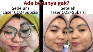 Laser Fractional CO2  Subsisi  Treatment Bopeng  cara menghilangkan bekas jerawat  hempas bopeng [upl. by Pallaten]