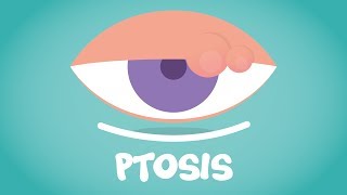 What is Ptosis [upl. by Nyliak858]