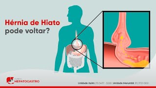 Hérnia de Hiato pode voltar  Clínica Hepatogastro [upl. by Ashia]