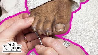 Twisting Turning and Curling Toenails Pedicure Tutorial [upl. by Nerrad]