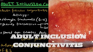 ADULT INCLUSION CONJUNCTIVITIS [upl. by Ladin]