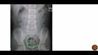 Constipation for USMLE [upl. by Enirol]