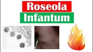 Roseola Infantum Sixth Disease  Symptoms Fever amp Rash in Infants Diagnosis Treatment [upl. by Oyam]