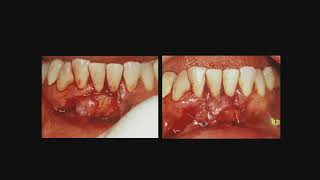 Lecture 18 – Surgical Management of the Mandibular Frenum [upl. by Shantee]