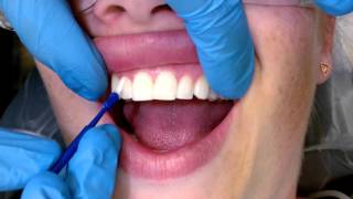 Tips For Applying Fluoride Varnish [upl. by Roter463]