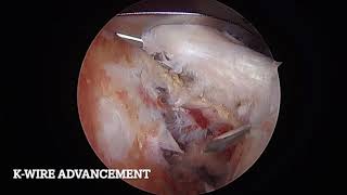 Arthroscopic Technique for Headless Compression Screw Fixation of Large Bony Bankart Fractures in An [upl. by Gillan]