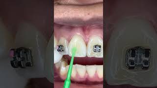 ¡🔥Proceso completo para instalar los brackets 😬 metálicos🔥 [upl. by Anelac]