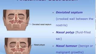 The Pathophysiology of Rhinosinusitis [upl. by Marasco541]