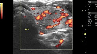 Focal acute viral thyroiditis left lobe with multinodular goiter ultrasound color Doppler video [upl. by Dilks]