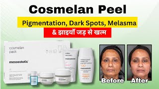 How to get rid of hyperpigmentation  Melasma  Cosmelan Peel Treatment Atomicclinicofficial [upl. by Tennaj404]