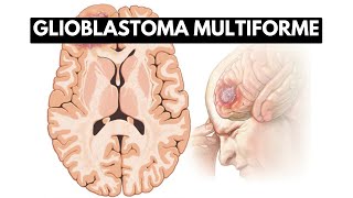 Inside Glioblastoma Multiforme A Journey into the Deadliest Brain Tumor [upl. by Gunter]