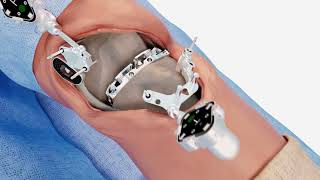 Balanced Knee Replacement Surgery by Exactech [upl. by Sension]