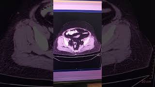 CT Scan Abdomen with contrast [upl. by Heinrick]