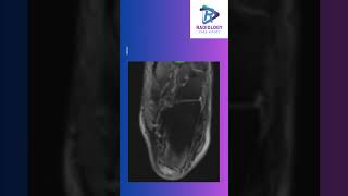 Tendoachilles insertional tear [upl. by Forelli]