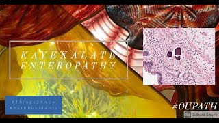 Kayexalate enteropathy [upl. by Bray482]