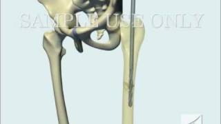 Femoral Fracture Fixation Surgery Intramedullary Nail [upl. by Schaeffer]