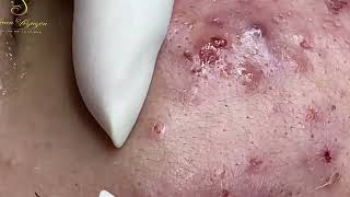 Loan Nguyen Acne Treatment 1611h [upl. by Kcid]