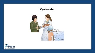 Cystocele [upl. by Reinaldos]