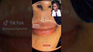 An Acne Sufferer REACTS to VIRAL TIKTOK PIMPLE POPPING VIDEO lip acne  Blackhead Extraction [upl. by Magner314]