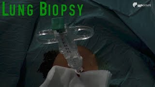 Lung biopsy [upl. by Anod]