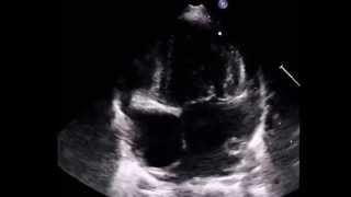 Tricuspid Atresia IIC [upl. by Yankee]