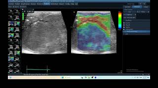 IQ 279 LIVER ULTRASOUND HEPATOMA ECHOPAC ANALYSIS ECHOCARDIOGRAPHY ELASTOGRAPHY 2 [upl. by Adnaluy]