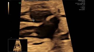 Ecocardiografía fetal Como evaluar el tabique interauricular [upl. by Enirroc]