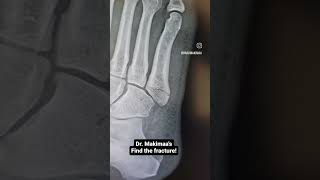 Find the fracture fifth metatarsal base avulsion fracture [upl. by Ikin]