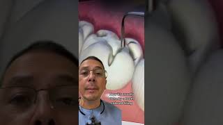 How Does a Dentist Fill a Cavity  View Mobile Dental [upl. by Lawry913]