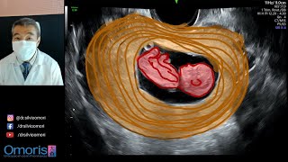 SANGRAMENTO no primeiro trimestre Gravidez 10 semanas Imagens em 3D 4D [upl. by Ardnos]