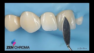 Direct Anterior Restoration with only ZENCHROMA and its supplemantary material OPAQUER [upl. by Aleekat28]