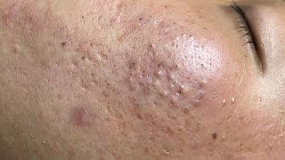 ACNE TREATMENT VU QUYNH MI Blackheads On Boy Face 2024 [upl. by Lasala652]