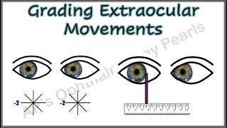 Grading Extraocular Movements [upl. by Sokil82]