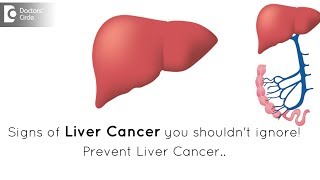 Liver cancer  Prognosis Prevention Treatment [upl. by Lynden67]