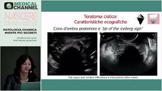 Teratomi cistici struma ovarii fibromi fibrotecomi ovarici tumore di Brenner  S Del Forno [upl. by Gert113]