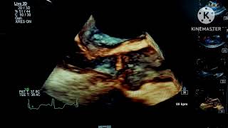 Systolic Anterior Motion SAM and dynamic LVOT obstruction [upl. by Yentihw]